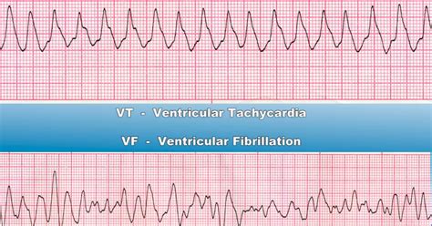 tachycardia manhattan cardiology manhattan ny