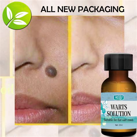 Warts Remover Oil Original Mole Remover Effective Skin Tags And Warts