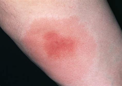 Wasp Sting Manchester Wasp Treatment