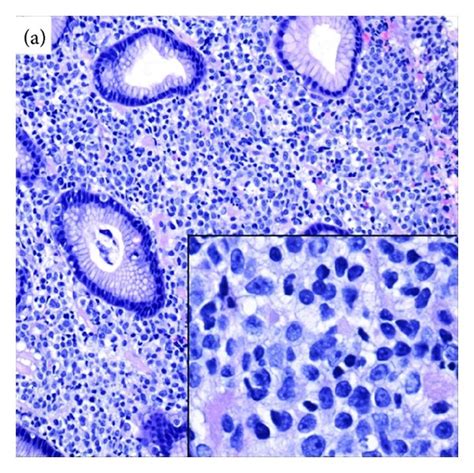 A Hematoxylin And Eosin Stain Showing The Gastric Biopsy With Download Scientific Diagram