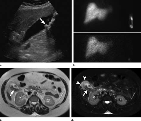 Acute Cholecystitis In A Year Old Woman A Right Upper Quadrant