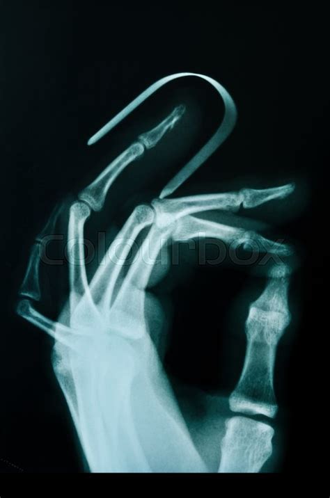 Xray Broken Finger