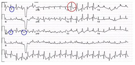 Akutní embolie EKG Medicína nemoci studium na 1 LF UK