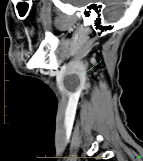 Metastatic Squamous Cell Carcinoma Neck Lymph Node Image