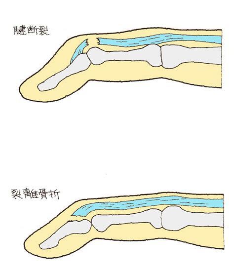 突き指（つきゆび） 福岡の弁護士による後遺障害・等級認定サポート