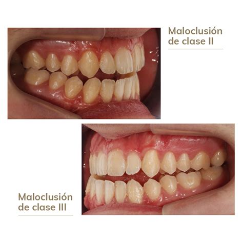 Maloclusi N Severa Resuelta Con Ortodoncia Invisible