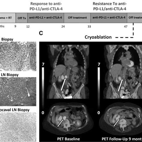 Cryoablation of an aortocaval lymph node in the setting of acquired ...