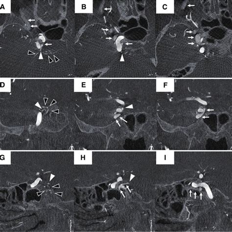 Axial A C Coronal D F And Sagittal G I Mpr Images Of Dra Show