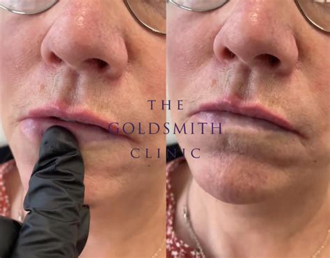 ‘it’ Finally Happened A Scary Filler Complication Vascular Occlusion The Goldsmith Clinic