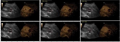 Volumetric Quantitative Contrast Enhanced Ultrasonography Evaluation Of