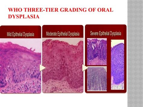 Epithelial dysplasia