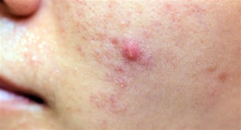 Acne Papules: Causes, Treatments, Natural Remedies, Do's and Don’ts