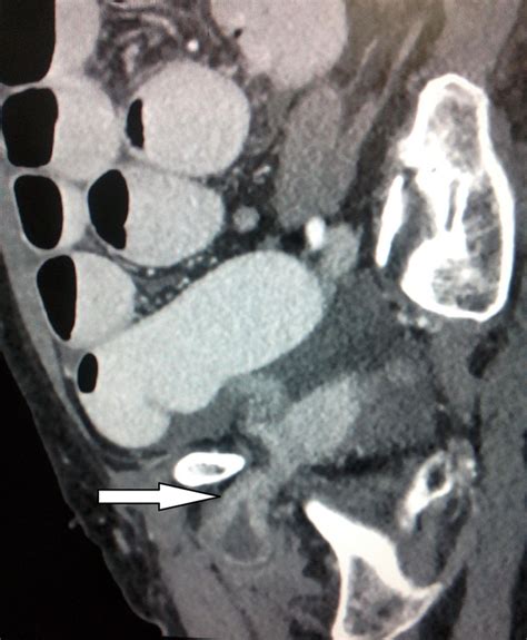 Strangulated Obturator Hernia Bmj Case Reports