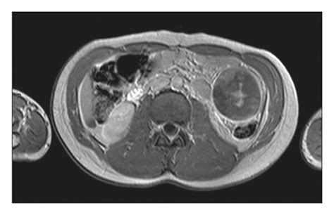 A Rare Case Of Spontaneous Hemorrhage In A Giant Accessory Spleen In A