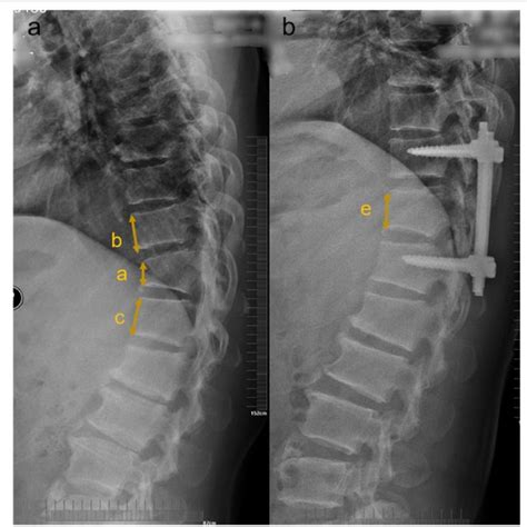 Radiographic measurement of fractured vertebral body. a Preoperative ...