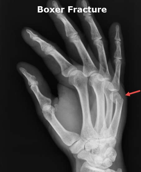 Popular Fracture Names Bone And Spine