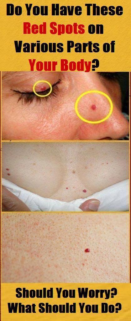 Do You Have These Red Spots On Various Parts Of Your Body Should You