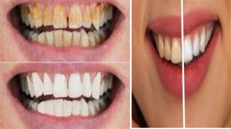 Teeth Whitening At Home In Minutes How To Whiten Your Teeth