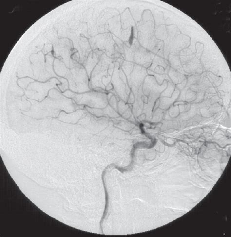 Injection Of Right ICA Lateral View 1992 Figure 6 Injection Of Right