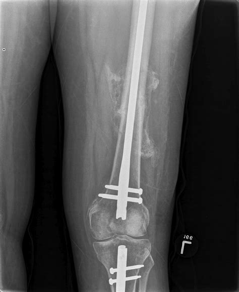 Femoral Shaft Fractures The Bone School