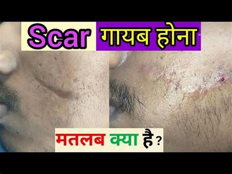 Scar Revision Surgery For Cheek Scar Best Result Of Scar Revision