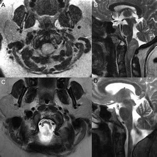 Preoperative Axial A And Sagittal B T Mri Demonstrate A