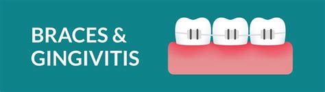 Gingivitis With Braces Gums Swelling Over Braces Swollen Gums