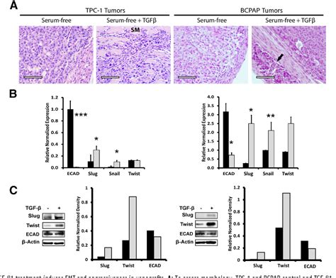 Figure 2 From The Roles Of The Epithelial Mesenchymal Transition Marker Prrx1 And Mir 146b 5p In