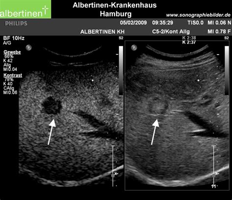 Leber Metastase Km Sono Pfeile Doccheck
