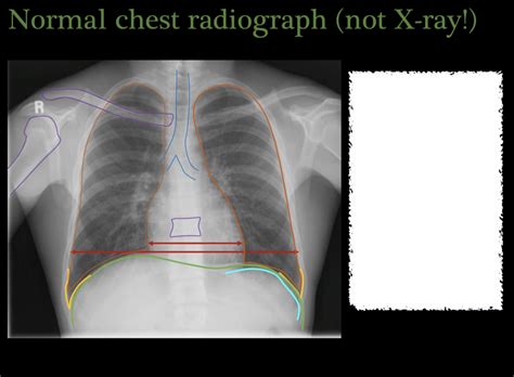 Normal Chest Radiograph Diagram Quizlet