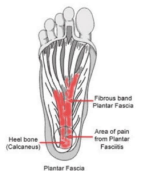 Plantar Fasciopathy Befit Training Physio