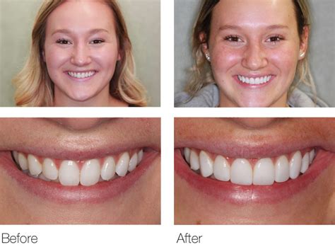 Composite Veneers Pros Cons Procedure Cost And