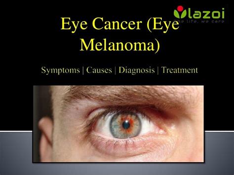 Eye Cancer (Eye Melanoma): Symptoms, Causes, Diagnosis and Treatment.