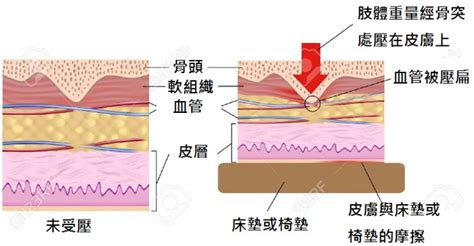 正確認識長輩的壓瘡治療與預防 顧名思醫