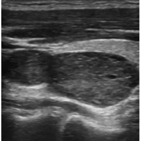 Ultrasonography Of The Thyroid Gland Revealing Two Solid Hypoechoic