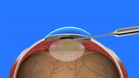 Cataract Surgery Youtube