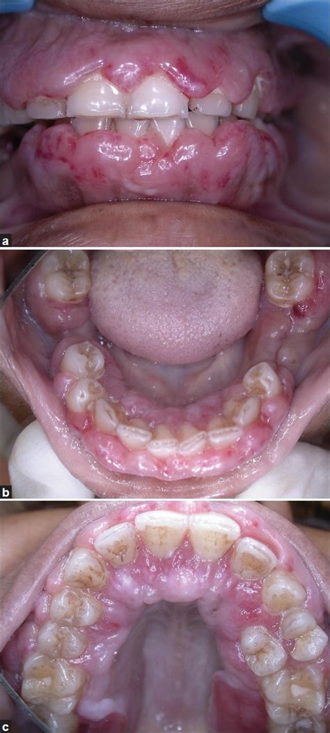 A Reduction In The Inflammation And No Increase In The Gingival