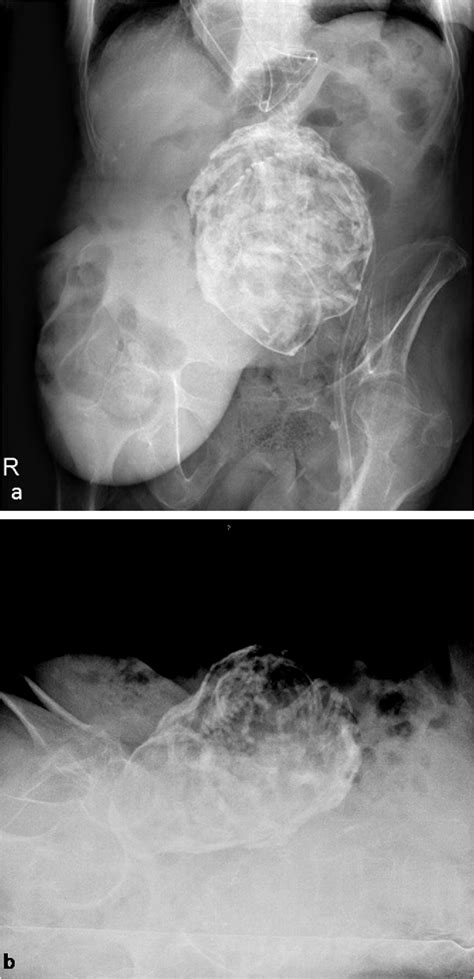 Figure 1 From An Unusual Cause Of Intra Abdominal Calcification A Lithopedion Semantic Scholar