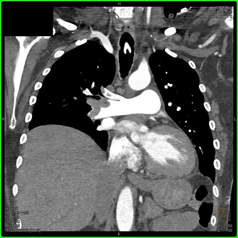 Thrombus In The Left Atrial Appendage And Pulmonary Embolism Chest