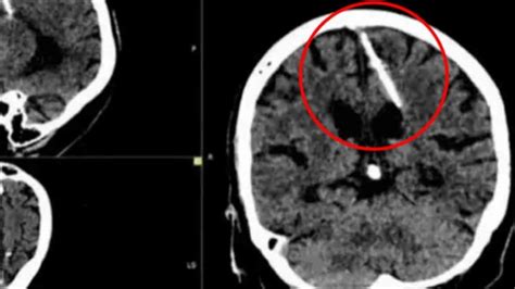 Mujer de 80 años tiene una aguja insertada en su cerebro