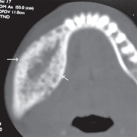 Orthopantomogram Opg Shows A Well Defined Multilocular Radiolucency