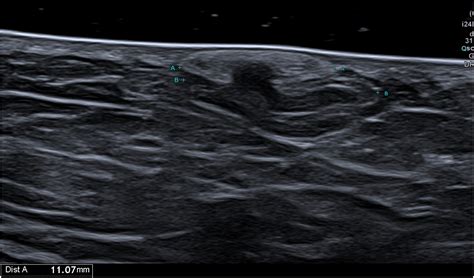 Herniated Superficial Lipomas In Gluteal And Thigh Support Areas A Special Clinical Ultrasound