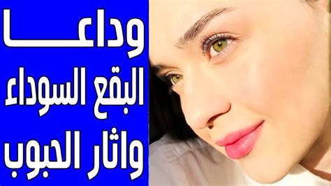 علاج اثار الحبوب والبقع السوداء ووردز