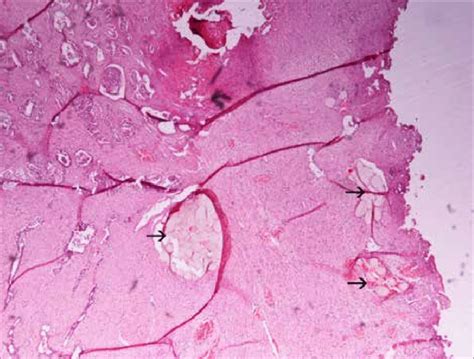 Image From Histologic Examination Hematoxylin Eosin Stain Original