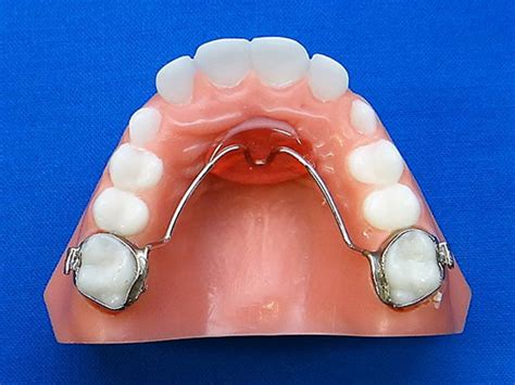 Palatal Holding Arch