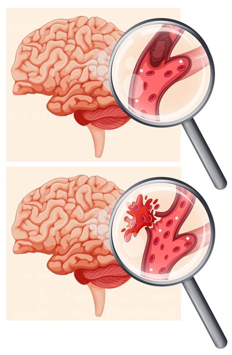 Accidente Cerebrovascular ACV