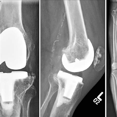 Postoperative Radiographs Of Case Total Knee Arthroplasty Was