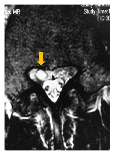 Preoperative Magnetic Resonance Imaging A Sagittal T2 Weighted Download Scientific Diagram