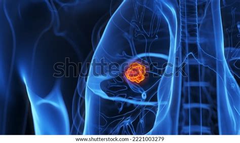 3d Rendered Medical Illustration Lung Tumor Stock Illustration