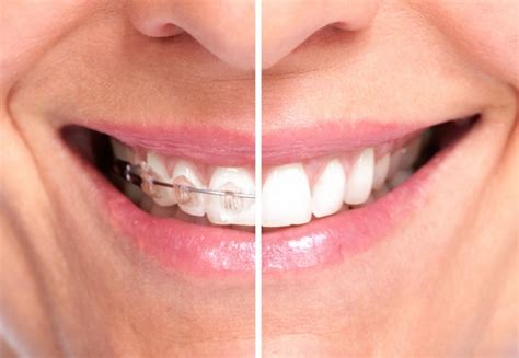 Patient Results Teeth Straightening Braces Invisalign